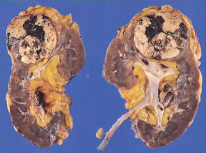 腎がん取り扱い規約第5版より引用