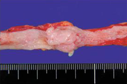 転移のない腎盂尿管がんの治療
